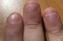Как лечить онихолизис ногтей